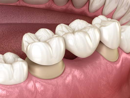 When A Dental Bridge May Be Recommended