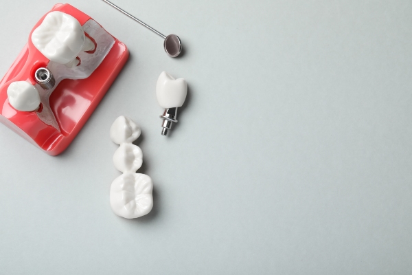What To Expect Before, During, And After Dental Bridge Placement
