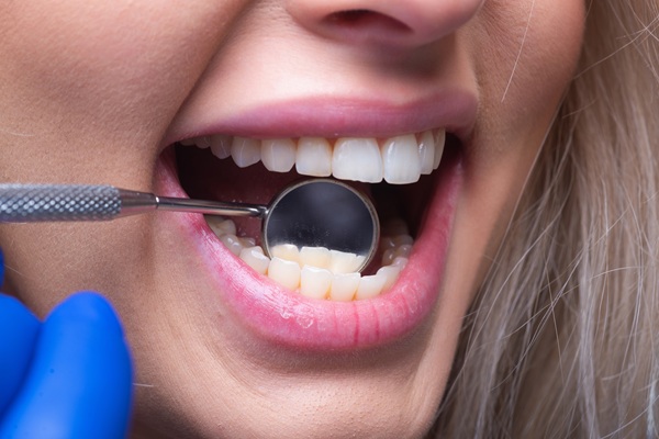 What To Ask Your Dentist About A Dental Cleaning