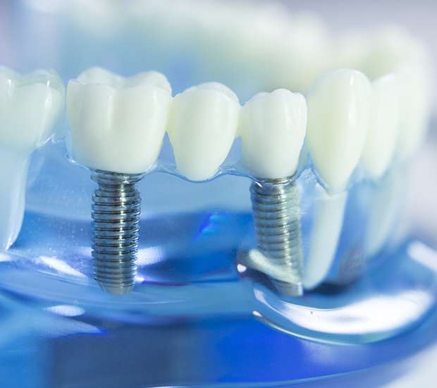 Troy Dental Implants