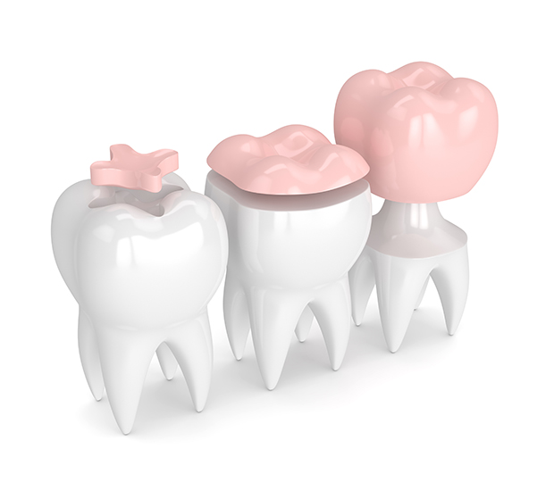 Troy Dental Inlays and Onlays