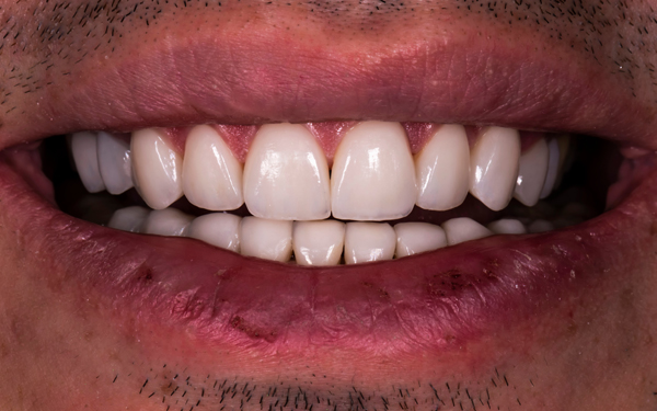 Myths And Facts About Dental Veneers